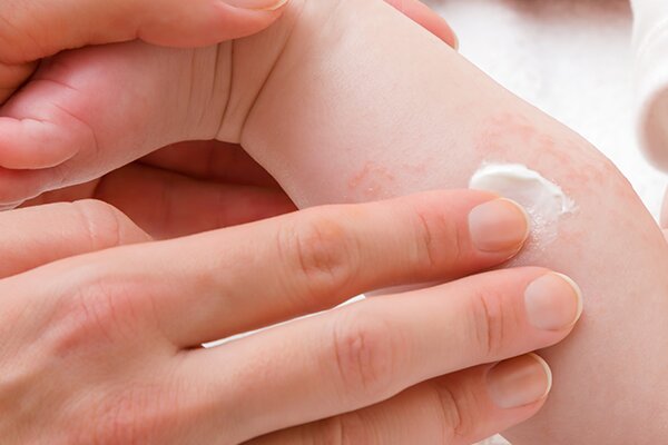 Tıbbi adıyla kserozis, derinin en üst tabakasındaki nem dengesinin bozulmasıdır.