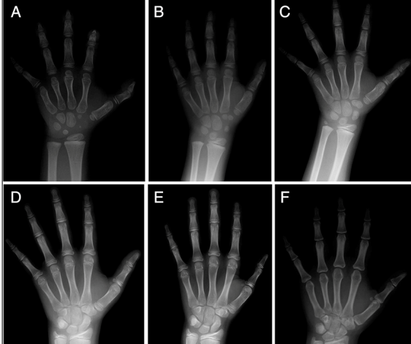 Kemik yaşı, çocuğun kemiklerinin olgunlaşma düzeyini değerlendirmek için kullanılmaktadır.