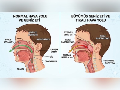 Geniz Eti Çocuğun Boyunu ve Hormonlarını Nasıl Etkiler?